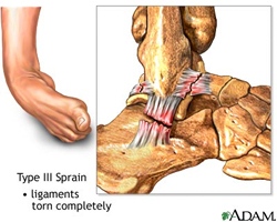 Ankle_Sprain.jpg