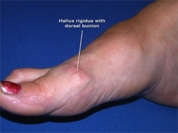 big toe arthritis kenőcs